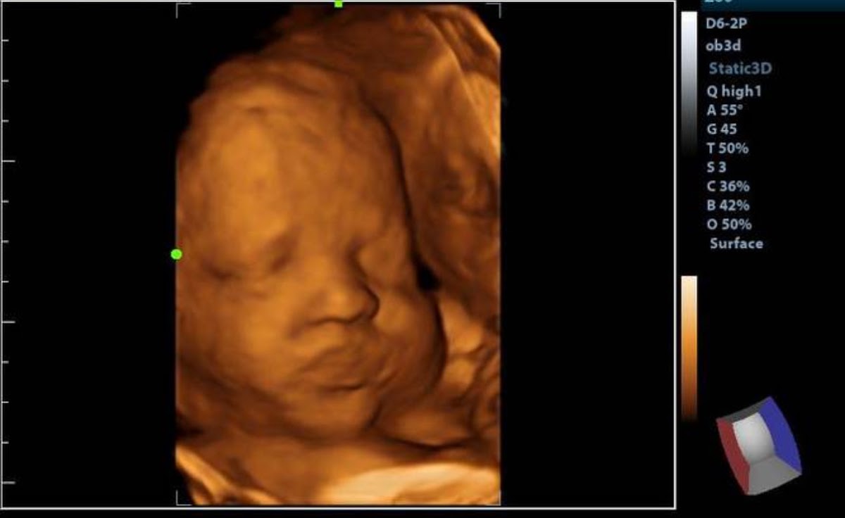 Tiny Treasures 3D/4D Ultrasound cover