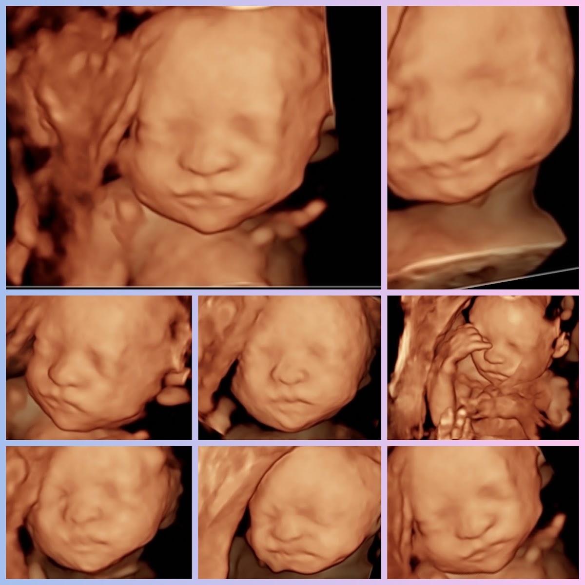 Ultrasound Techniques 3D/4D/5D baby imaging studio
