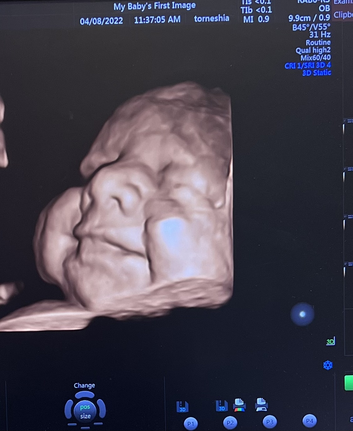 My baby's first image in Lawrenceville