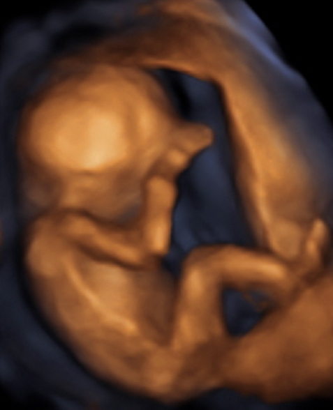 Ivue Baby 2D/3D/4D/5D Ultrasound Studio