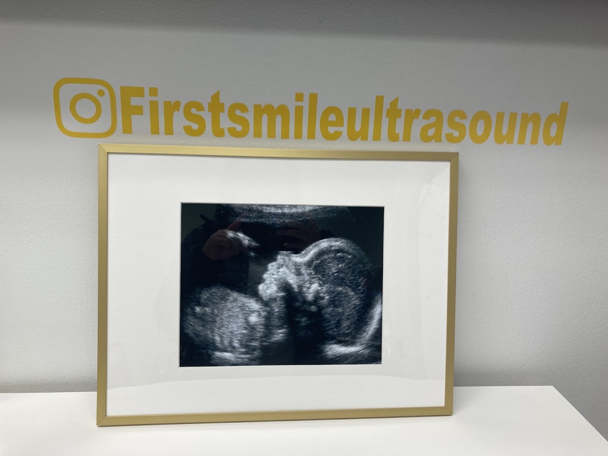 3D 4D First Smile Ultrasound