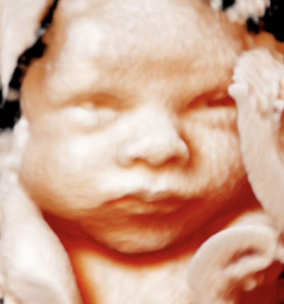 Stork Vision 3D/4D Ultrasound Katy