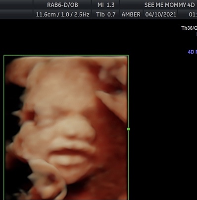 See Me Mommy 4D Ultrasound