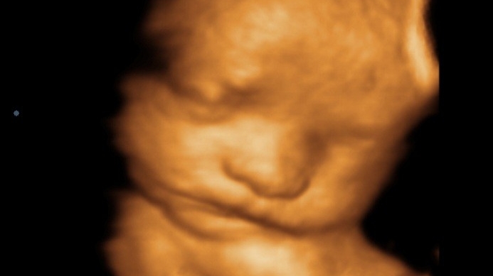 Peek-A-View 2D/3D/4D Ultrasound